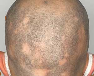 scalp micropigmentation before